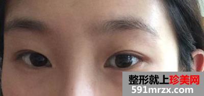 在北京做生物焊接双眼皮 期待效果哟