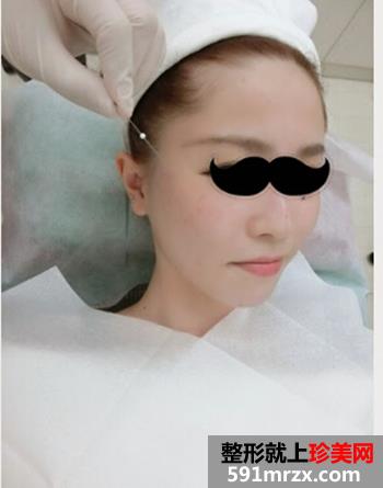 昆明艺星整形美容医院埋线提拉后 大小脸不见了