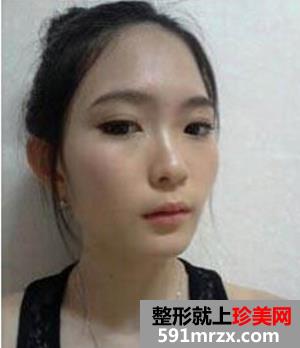 成都华博整形医院注射海薇玻尿酸半年了 快来看看效果