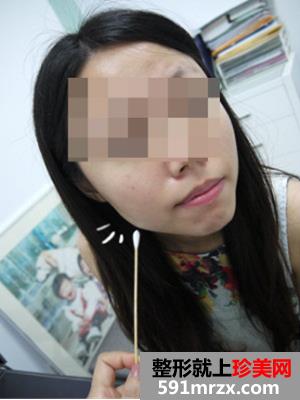 南京,友谊,整形医院,,瘦脸,圆脸,变成,锥子脸