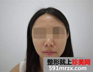 南京,友谊,整形医院,,瘦脸,圆脸,变成,锥子脸