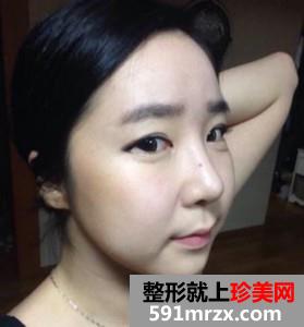 面部,吸脂,瘦脸,手术,恢复,过程,前后,对比,效果,图片