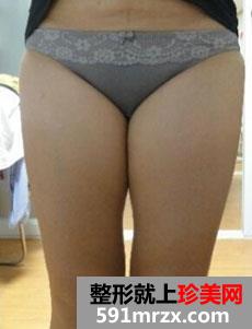 腿部整体吸脂术前后对比效果图和恢复真实经历