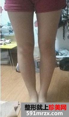腿部整体吸脂术前后对比效果图和恢复真实经历