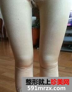 腿部整体吸脂术前后对比效果图和恢复真实经历