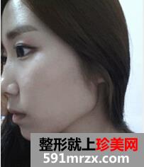 颧骨整形手术