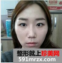 颧骨整形手术