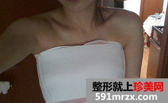 北京,中日友好,医院,马力,隆胸,怎么样,多少钱,案例
