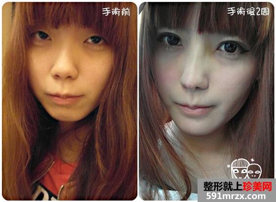 割双眼皮前后对比图,垫下巴前后对比图,美眉梦工场