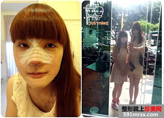 割双眼皮前后对比图,垫下巴前后对比图,美眉梦工场