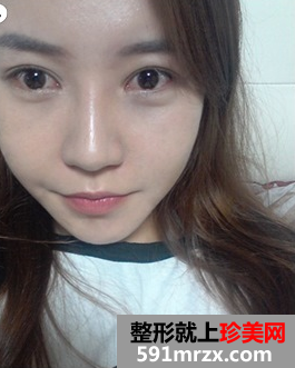 无痕双眼皮+颧骨缩小术前后效果对比图和恢复过程