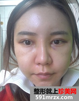 无痕双眼皮+颧骨缩小术前后效果对比图和恢复过程