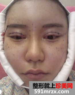 无痕双眼皮+颧骨缩小术前后效果对比图和恢复过程