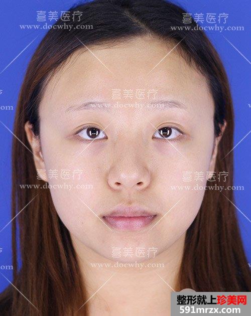 硅胶假体+鼻中隔软骨+耳软骨隆鼻 鼻综合术后1个月前后对比分享