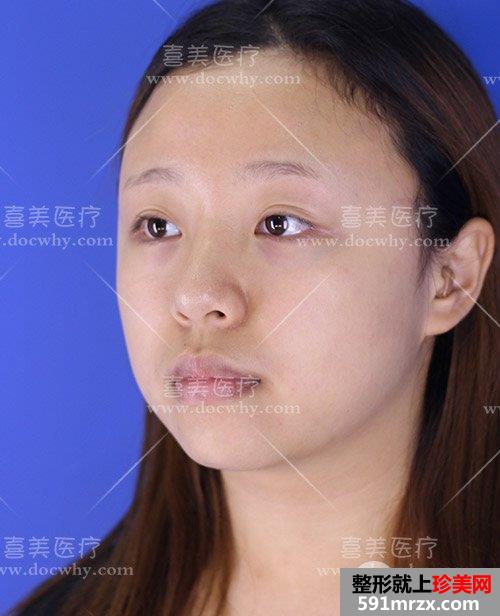 硅胶假体+鼻中隔软骨+耳软骨隆鼻 鼻综合术后1个月前后对比分享