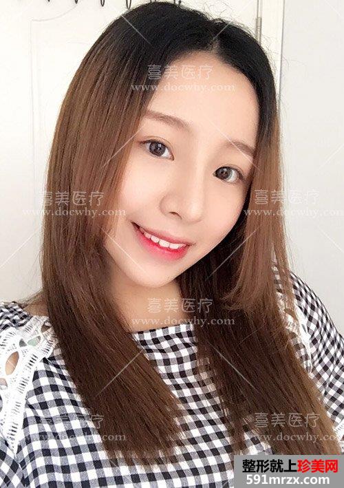 硅胶假体+鼻中隔软骨+耳软骨隆鼻 鼻综合术后1个月前后对比分享