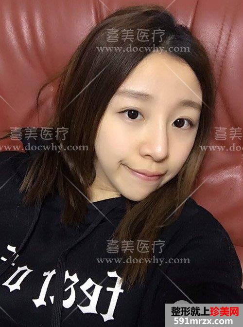 硅胶假体+鼻中隔软骨+耳软骨隆鼻 鼻综合术后1个月前后对比分享