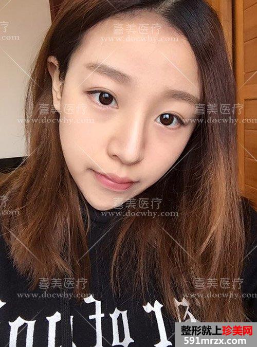 硅胶假体+鼻中隔软骨+耳软骨隆鼻 鼻综合术后1个月前后对比分享