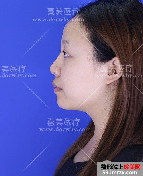 硅胶假体+鼻中隔软骨+耳软骨隆鼻 鼻综合术后1个月前后对比分享