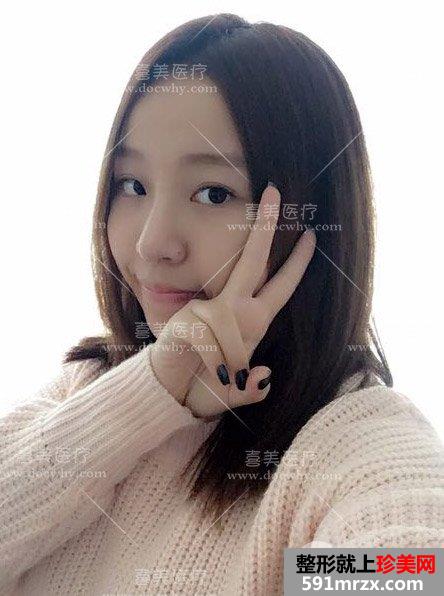 硅胶假体+鼻中隔软骨+耳软骨隆鼻 鼻综合术后1个月前后对比分享
