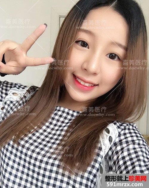 硅胶假体+鼻中隔软骨+耳软骨隆鼻 鼻综合术后1个月前后对比分享