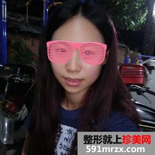 打瘦脸针三个月了 脸小了一大圈