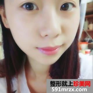 打瘦脸针三个月了 脸小了一大圈