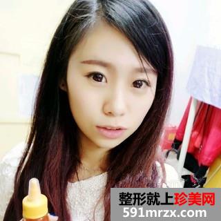 打瘦脸针三个月了 脸小了一大圈