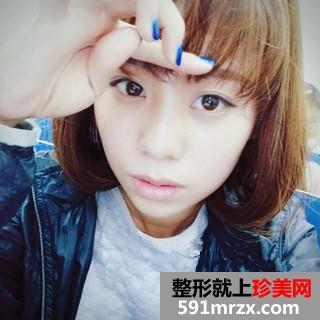 打瘦脸针三个月了 脸小了一大圈
