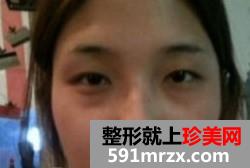 埋线双眼皮+激光治疗黑眼圈 像不像混血美女