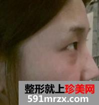 埋线双眼皮+激光治疗黑眼圈 像不像混血美女