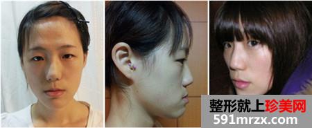 立体轮廓+贵族手术前后对比照片和恢复效果