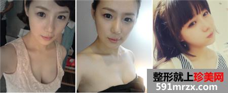 立体轮廓+贵族手术前后对比照片和恢复效果