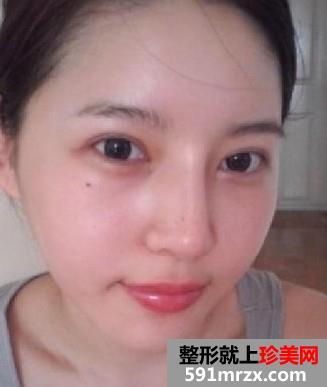 双眼皮+隆鼻+自体脂肪移植后变得超漂亮
