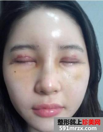 双眼皮+隆鼻+自体脂肪移植后变得超漂亮