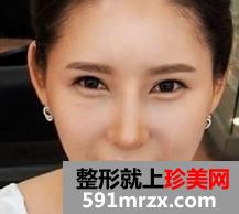 双眼皮+隆鼻+自体脂肪移植后变得超漂亮