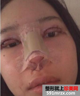 双眼皮+隆鼻+自体脂肪移植后变得超漂亮