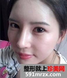 双眼皮+隆鼻+自体脂肪移植后变得超漂亮