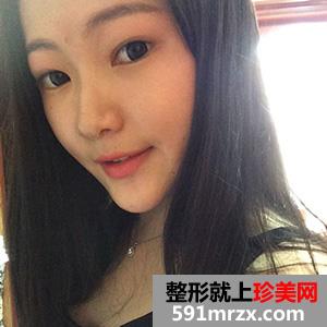 内双,怎么变,外双,看看,我的,手术,恢复,过程