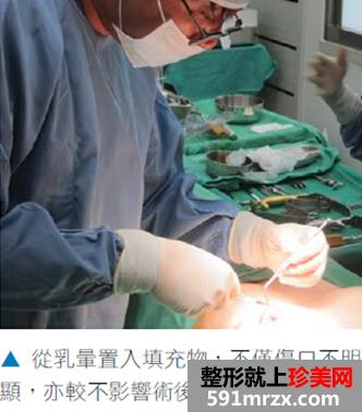 进口假体隆胸,沙滩比基尼美女