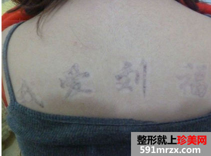 做了三次激光洗纹身后 终于把背上洗干净了