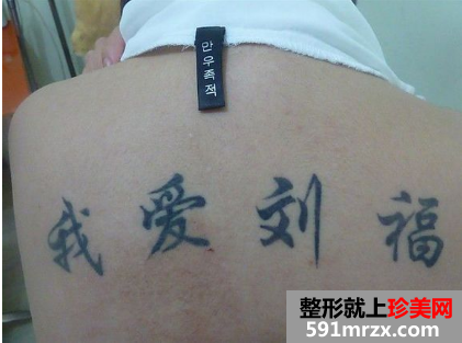 做了三次激光洗纹身后 终于把背上洗干净了