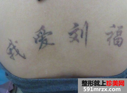 做了三次激光洗纹身后 终于把背上洗干净了