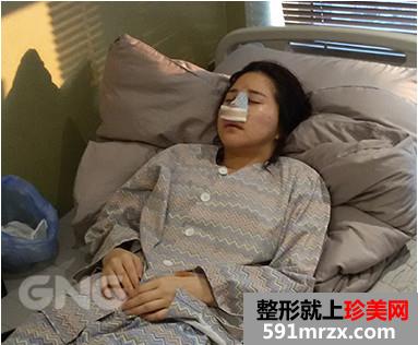 硅胶假体隆鼻整形手术前后效果对比图和恢复过程