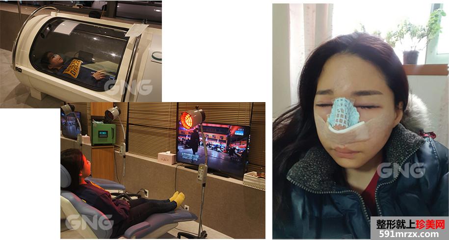 硅胶假体隆鼻整形手术前后效果对比图和恢复过程