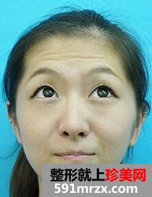 注射除皱效果怎么样
