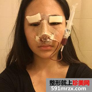 终于做了鼻综合整形，效果图分享