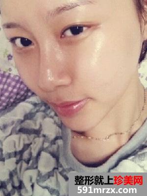 下颌角,磨腮削骨,整形,手术,恢复,过程,前后,对比,效果图