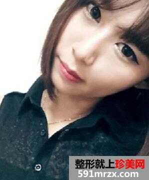 下颌角,磨腮削骨,整形,手术,恢复,过程,前后,对比,效果图