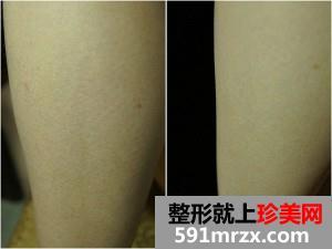 北京,八大处,激光脱毛,小腿吸脂,恢复,过程,效果图